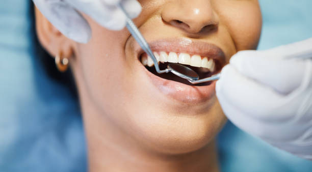 Best Knocked-Out Tooth (Avulsed Tooth) Treatment in St Matthews, SC